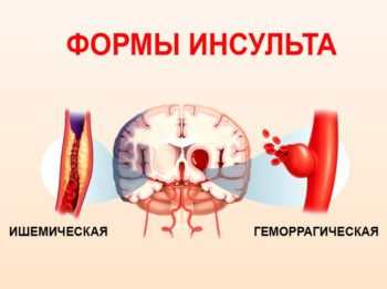 Ишемический инсульт: какая группа инвалидности оформляется? Как оформить нетрудоспособность после инсульта